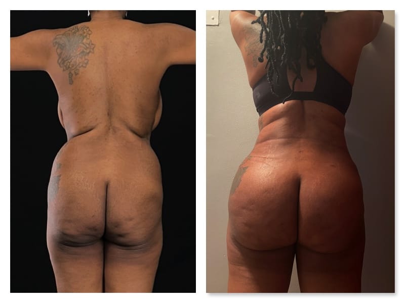 Brazilian Butt Lift Before & After Gallery - Patient 133183896 - Image 1