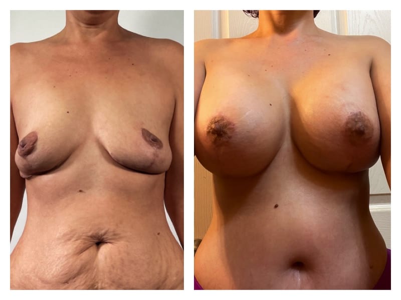 Mommy Makeover Before & After Gallery - Patient 133183886 - Image 3