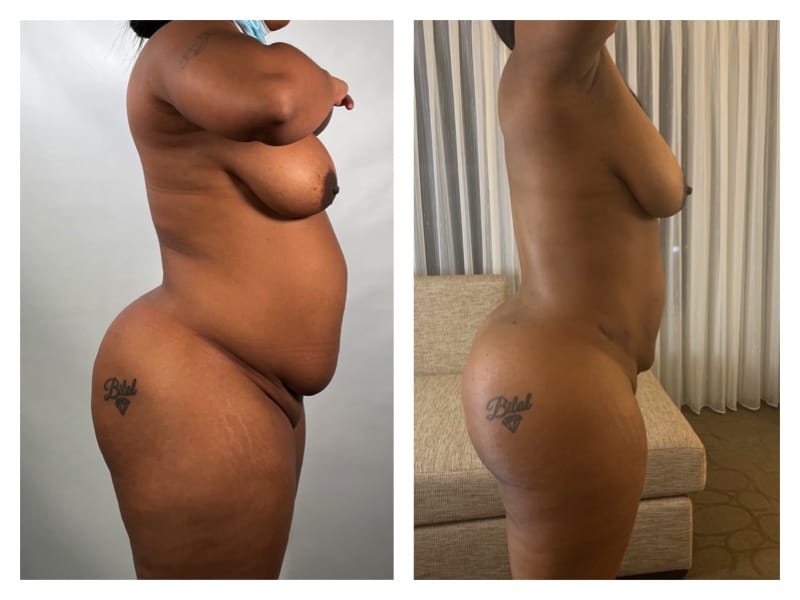 Brazilian Butt Lift Before & After Gallery - Patient 133183835 - Image 3