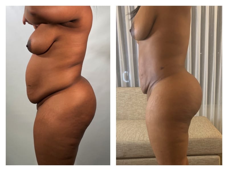 Brazilian Butt Lift Before & After Gallery - Patient 133183835 - Image 2