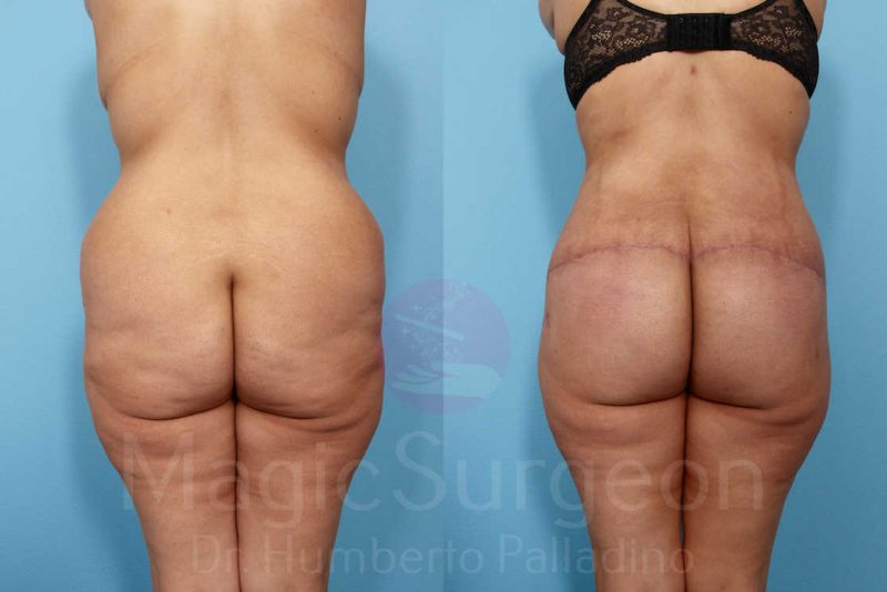 Brazilian Butt Lift Before & After Gallery - Patient 143542976 - Image 1