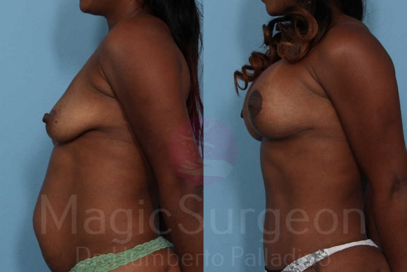 Mommy Makeover Before & After Gallery - Patient 133182311 - Image 3