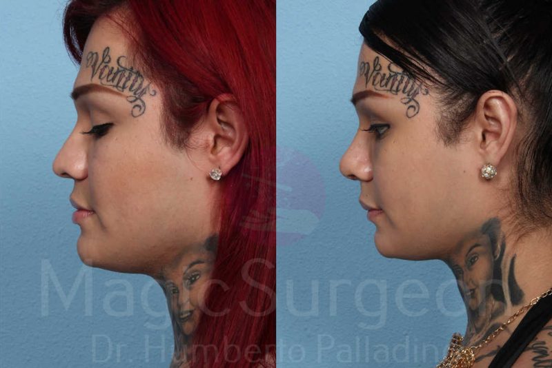 Rhinoplasty Before & After Gallery - Patient 133182407 - Image 3