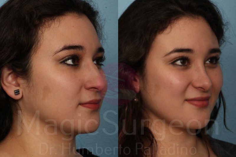 Rhinoplasty Before & After Gallery - Patient 133182415 - Image 4