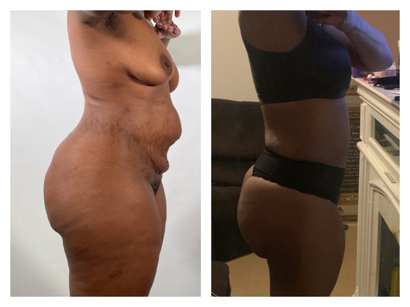 Liposuction Before & After Gallery - Patient 175515122 - Image 1