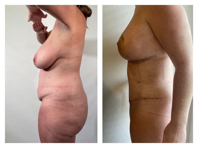 Breast Reduction Before & After Gallery - Patient 104266 - Image 1