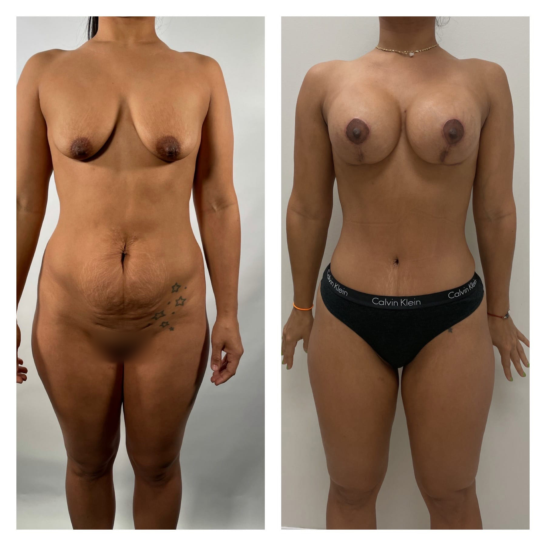 Mommy Makeover Before & After Gallery - Patient 133183823 - Image 3