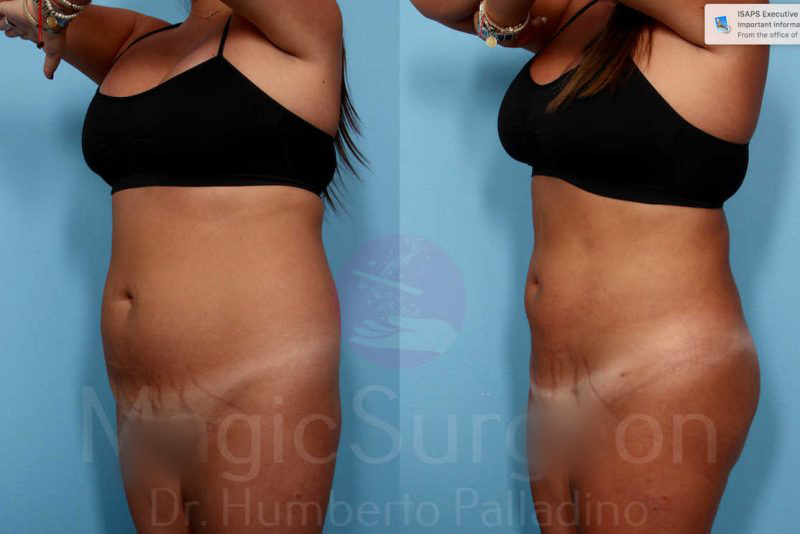 Liposuction Before & After Gallery - Patient 133182333 - Image 4